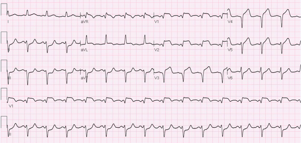Zach Jarou Md Mba On Twitter 5280em Anteroseptal Infarct Ventricular Free Wall Rupture If It Were An Inferior Stemi Concern Would Be Acute Mr 2 2 Papillary Rupture