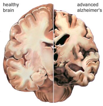 This is what happens to the brain without proper prevention. Share to save memories.