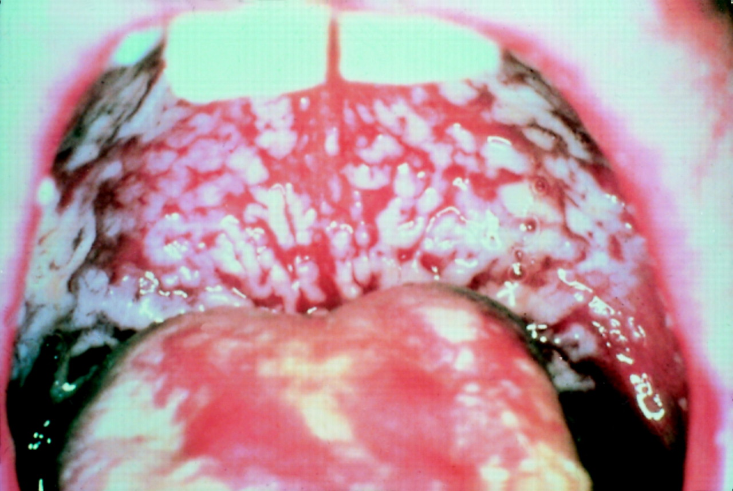 CandidaProtocol's tweet image. Thrush is a medical condition in which a fungus called Candida albicans overgrows in the mouth and throat.