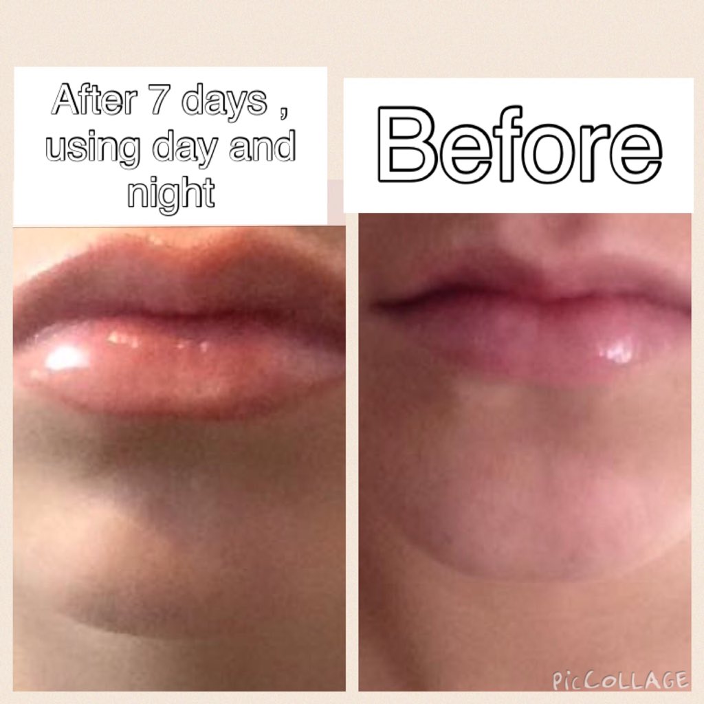 gemmaparker1966's tweet photo. 💜my gloss
#plump-lips #beauty #makeuplover #makeup #LipGloss #LIPS #musthavebox https://t.co/WYeRLTrUKA