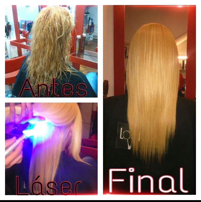 brushing progresivo con laser