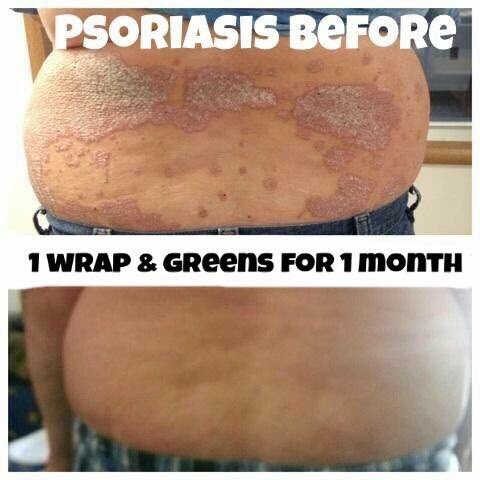 Ali_Cayemberg's tweet photo. These wraps are amazing!! Message me to hear all the benefits! #psoriasis #healing https://t.co/gra3vbnVad