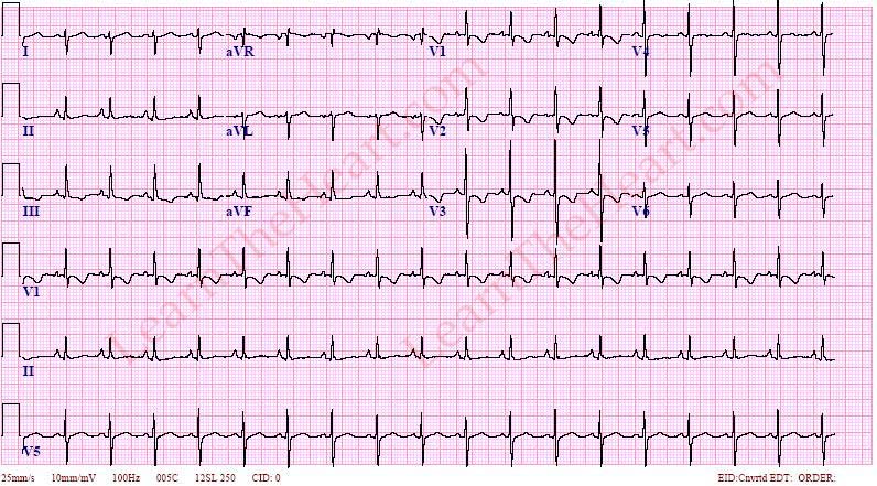 Right Ventricular Hypertrophy #ECG:

R:S > 1 in V1 in absence of other causes

OR

R wave in V1 > 7 mm