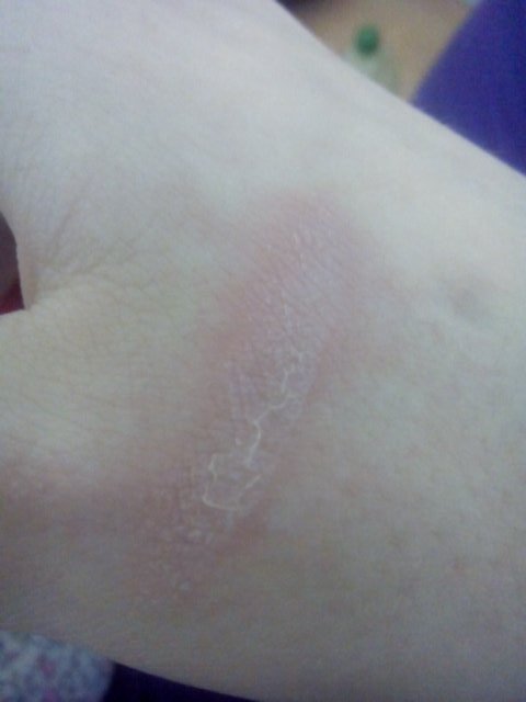 Clock_work_Nat's tweet image. [Uhg..the oven is painful,seriously even though it's a first degree burn]