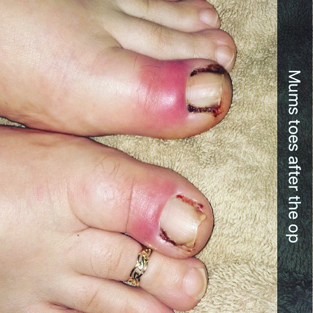 JessLouKnox1891's tweet photo. Mums toes after the op #ToeOperation #SoreToes #InGrowingToeNails https://t.co/dJTir40AdZ