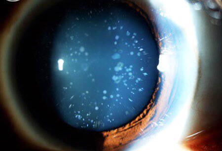 SaludVisual_Mx's tweet photo. Las #Cataratas pueden ser de diferentes tipos, acude a consulta. #Salud @NoInvisibles @Medicina_TV @SaludToday https://t.co/eyLESMbLfc
