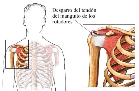 ¿Qué es el desgarro del manguito rotador?  ow.ly/UnK70