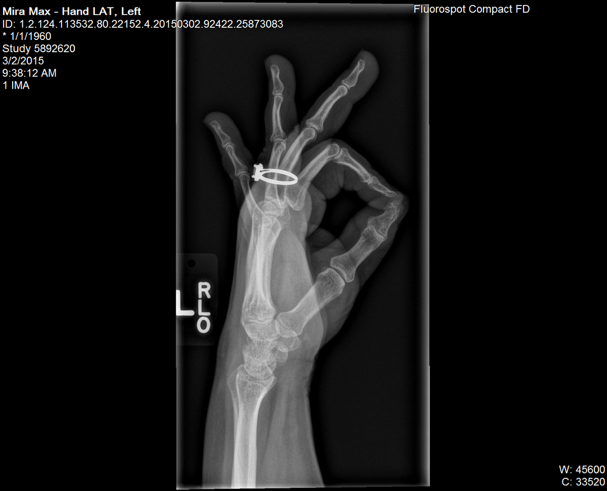 SiemensHealth's tweet photo. Röntgen produced the 1st X-ray image, a picture of his wife’s hand. Look at how far technology has come since then! https://t.co/Mv7GPXR9Jd