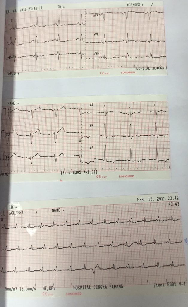 khairul_hafidz's tweet photo. #QuizForMedStud
74, male
P/w typical angina pain
In ward, SOB RR48, BP 186/116,spo2 92%
Lungs: crepts
Diagnosis? https://t.co/I18OJLW0dL