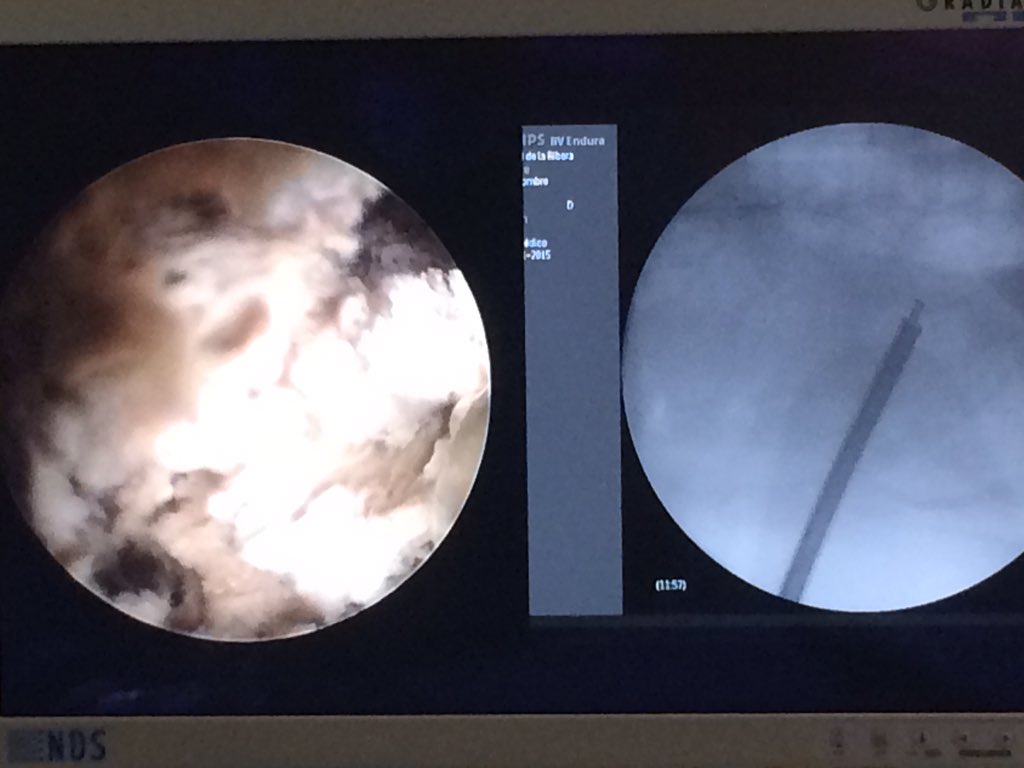 BMI 48, Supine Galdakao PCNL.; Difficult case complete resolution with this approach.