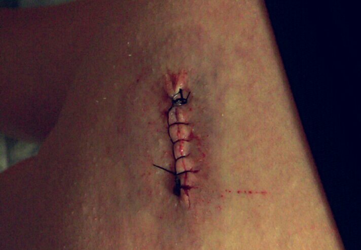 hannah_fitzsim's tweet photo. Got 6 stitches for the first time today. #stitches https://t.co/HDIo4yKDEY