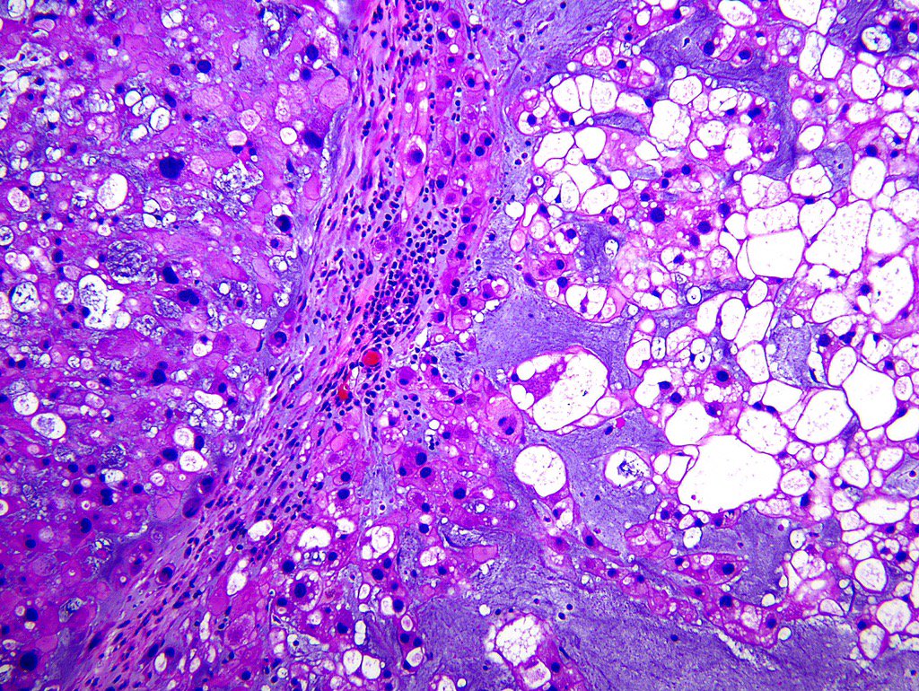 SGottesmanMD's tweet photo. Clival chordoma. Skull base tumor. Physaliferous cells, fibrous septa, myxoid stroma. Credit:https://t.co/RazRm6k6CJ https://t.co/UJn7AxNJMr