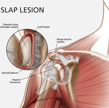 spinalogy's tweet photo. Forceful bending of arms may tear your labrum cartilage. This injury is called #SLAPLesion & cause severe pain. https://t.co/ALbP5UHHqc