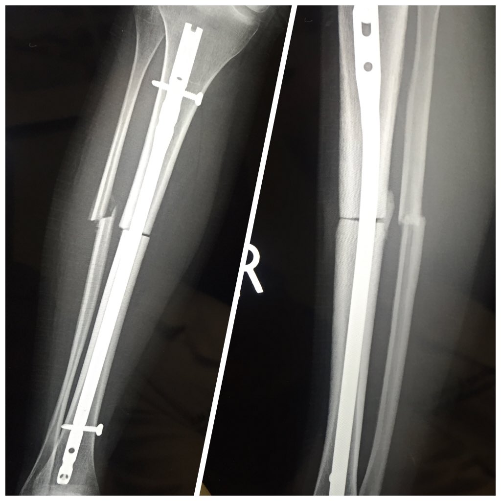 shelby_howe's tweet image. #bonegrowth #tibfib #osteotomy #ijustwannaride
