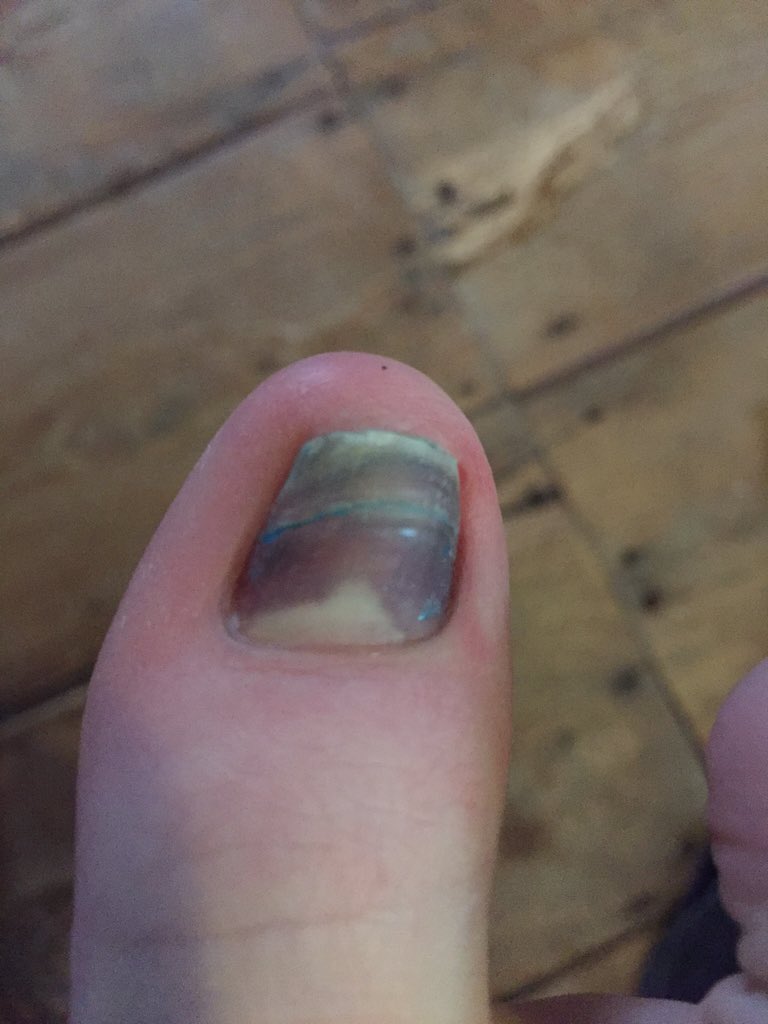 Liz_ORiordan's tweet photo. 2 more days til my final chemo. Hoping my big toe nail hangs on for the duration #chemonails #breastcancer https://t.co/tQr1WM500K