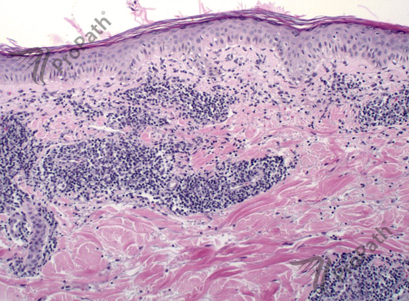 RyanHickMD's tweet photo. Tumid #lupus #clue: Superficial &amp; deep perivascular lymphocytes w/ focal interface &amp; mucin. #dermpath #pathology https://t.co/X9jB8xLH3i