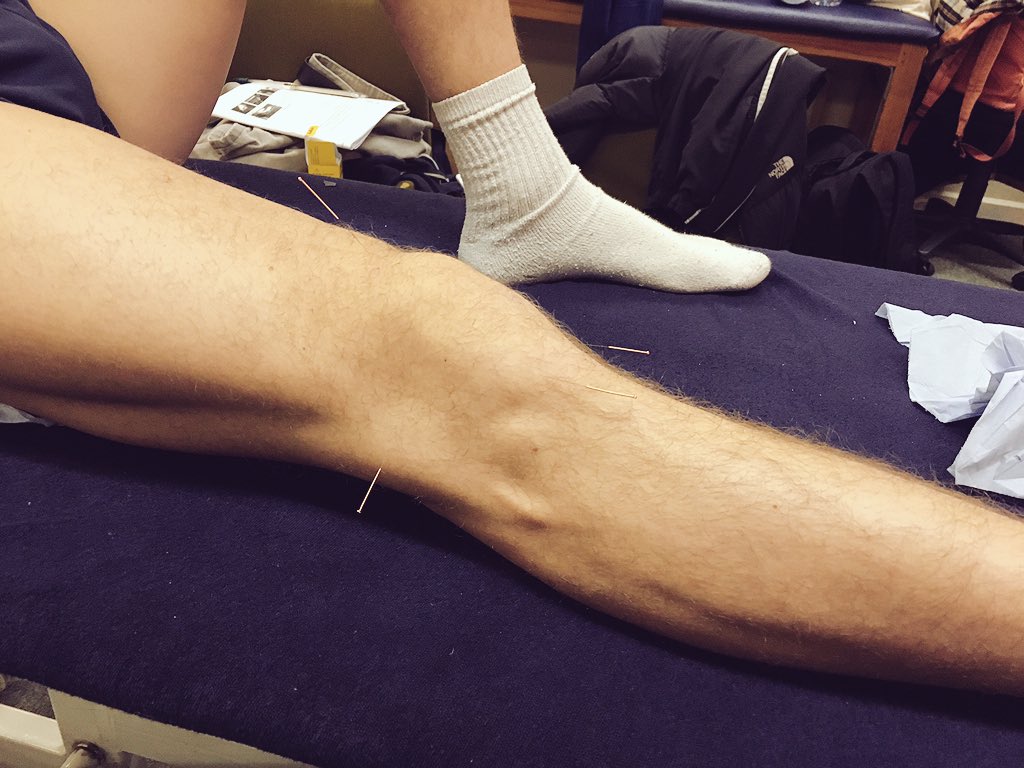 david_platten's tweet image. Dry needling @OfficialBCOM. @PositiveClinic #osteopathy #treatment #anotherstring