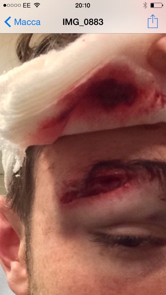 KingsMacRugby's tweet image. Really nasty gash to Macca's head! Didn't stop the 1st XV boys performing brilliantly to beat a strong Calday side!