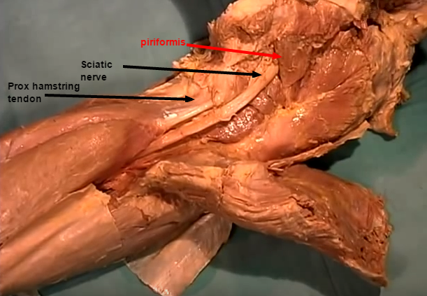 Nice pic of prox hams tendon and sciatic nerve under piriformis