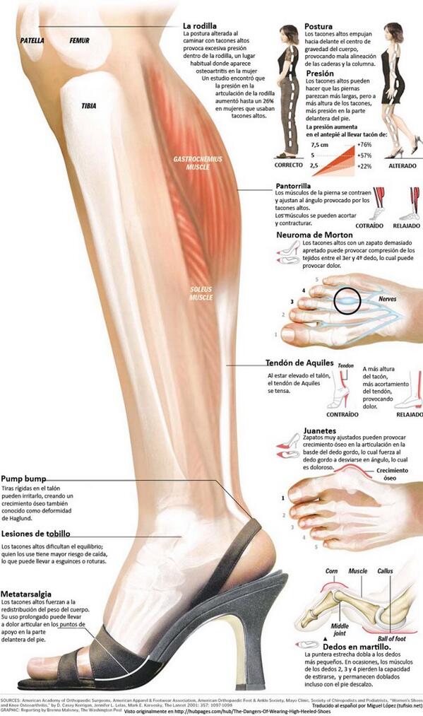cgcfe's tweet photo. El efecto de los tacones en los pies. #Fisioterapia vía @trauma_modern https://t.co/H8RcVDWj4t