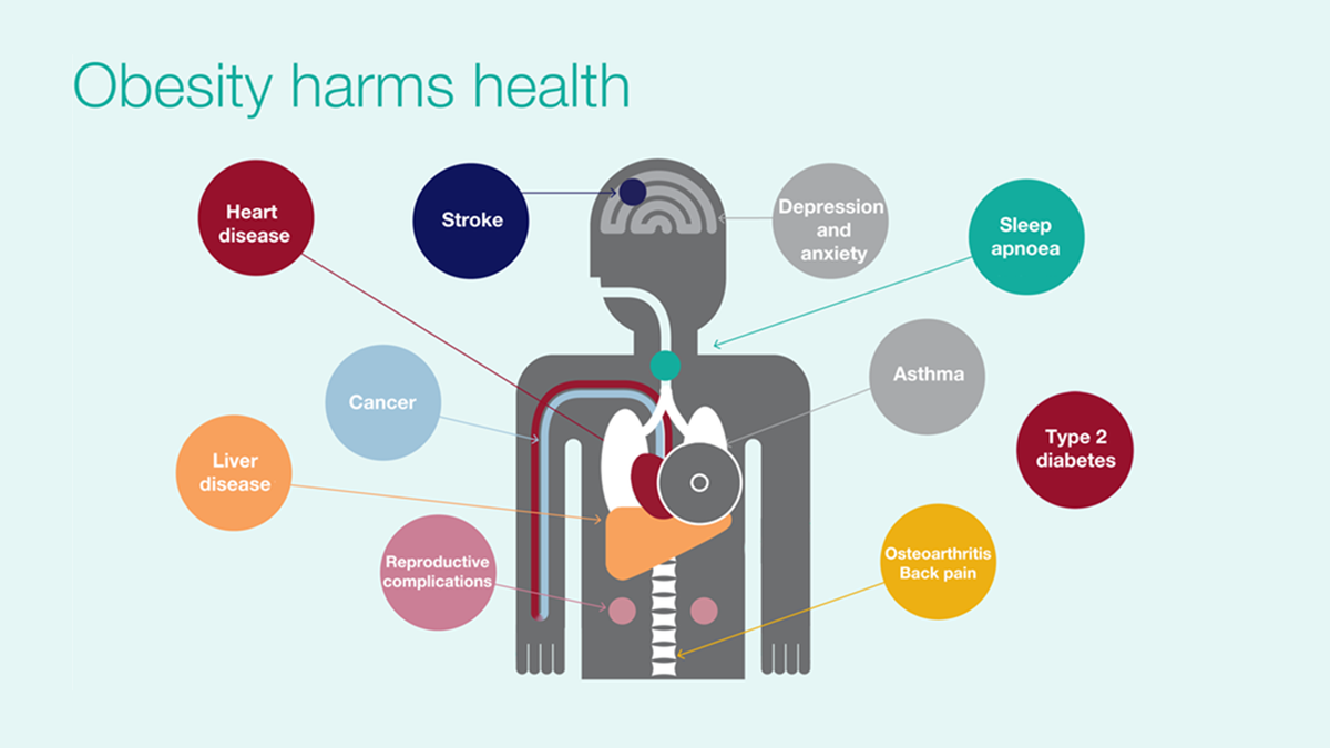 ProfKevinFenton's tweet photo. Useful graphic slide set: Making the case for tackling obesity - why invest? https://t.co/DtdqilKRQm #PHEDataWeek https://t.co/vsjyAwTLpn
