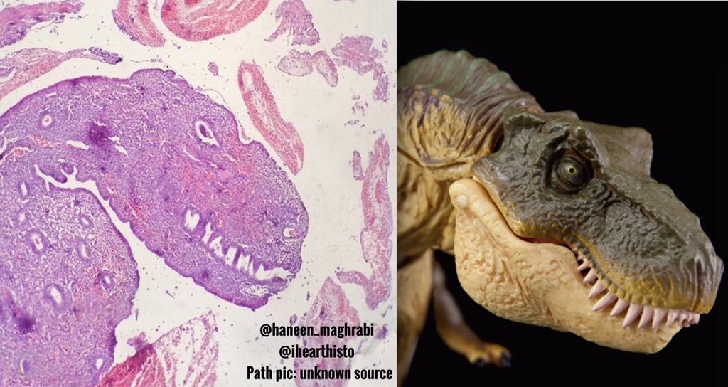 JMGardnerMD's tweet photo. Endometrium mimics T-Rex. Classic #pathart shared 1st by @haneen_maghrabi &amp; @ihearthisto  #pathology #science #art https://t.co/Ovynx7wUDT