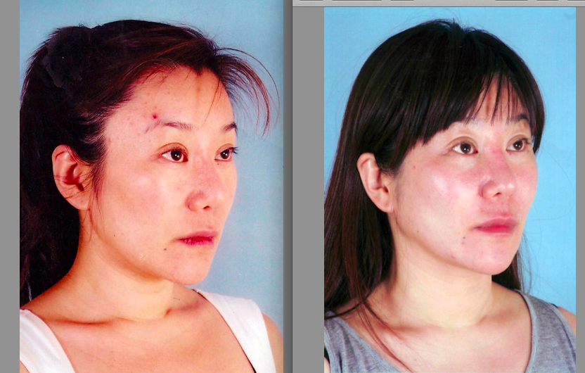DrGiampapa's tweet photo. #tbt before and after stem cell face lift #antiaging #stemcells #stemcellfacelift https://t.co/7FnUBjr08S https://t.co/VZjNWHZu6R