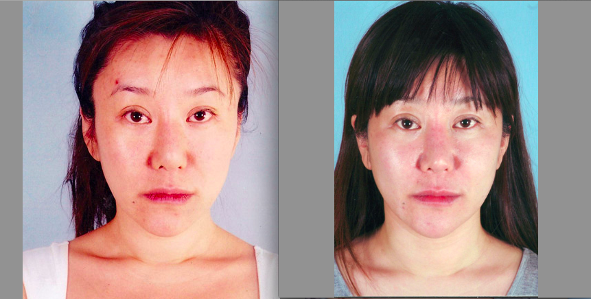 DrGiampapa's tweet photo. #tbt before and after stem cell face lift #antiaging #stemcells #stemcellfacelift https://t.co/7FnUBjr08S https://t.co/VZjNWHZu6R