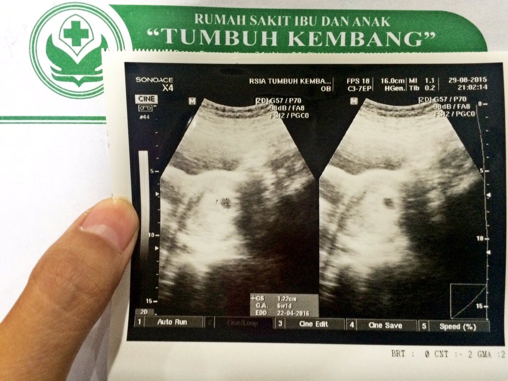 vickaferdian's tweet photo. Usg 6week Puji Tuhan, sehat&amp;lancar😇 https://t.co/2zrFSoYCFx