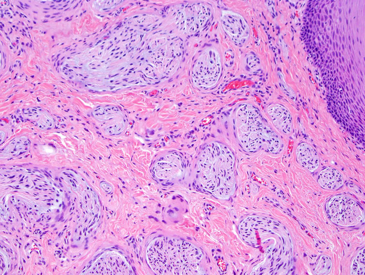 #Pathology #Pediatrics 8 Y-old girl with MEN2B. Mucosal (gingival) neuromas.