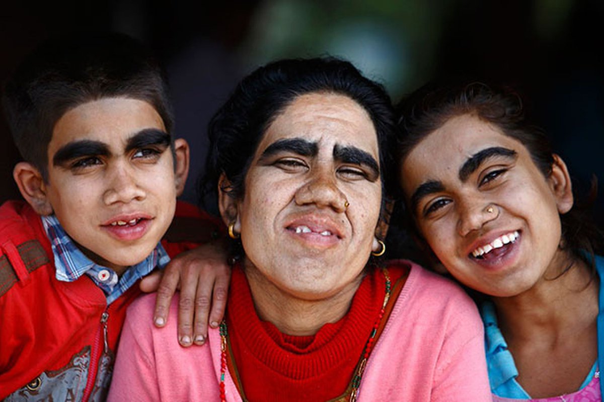 Werewolf family transformed by laser hair-removal treatment goo.gl/c5wXJ2