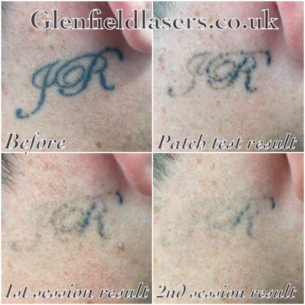 How to Get Rid of a Stick and Poke Tattoo  Removery