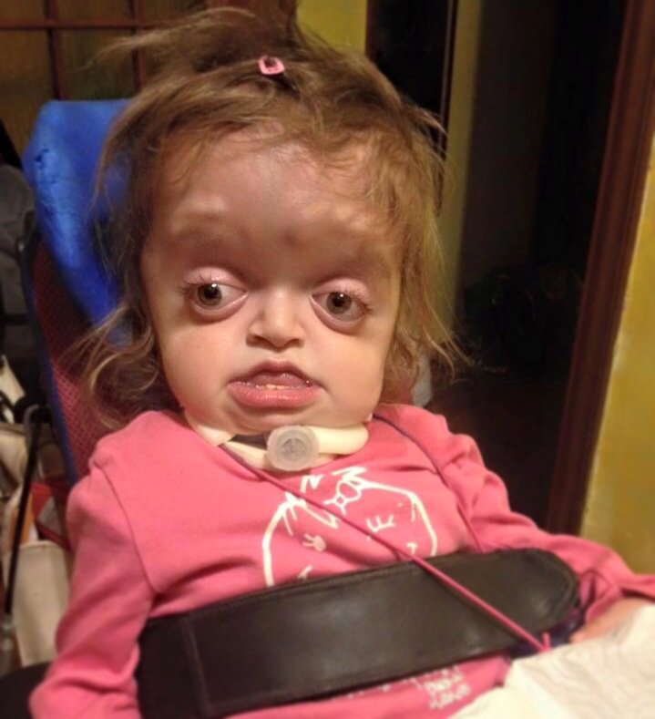 CaroneTweet's tweet image. Lei è Alice, combatte contro una malattia rara. Oggi compie 3 anni: le facciamo tutti insieme gli auguri?