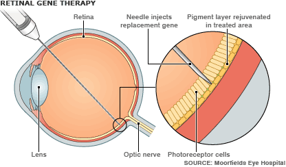 ClinicaLondon's tweet photo. Inherited retinal dystrophies &amp; updates #retinalgenetherapy @MichelMichaelid @aao_ophth 
https://t.co/eg6tXhFh1J https://t.co/VStMLblTqE