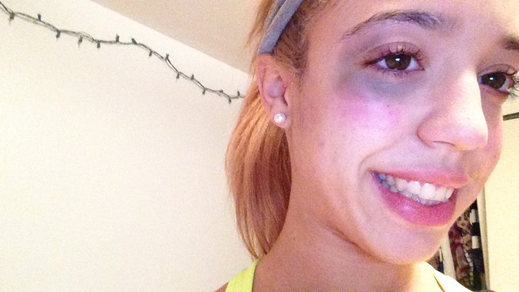 yoitssLUA's tweet image. It was well worth it! #dub 
#illbounceback #blackeye powderpuff football!!