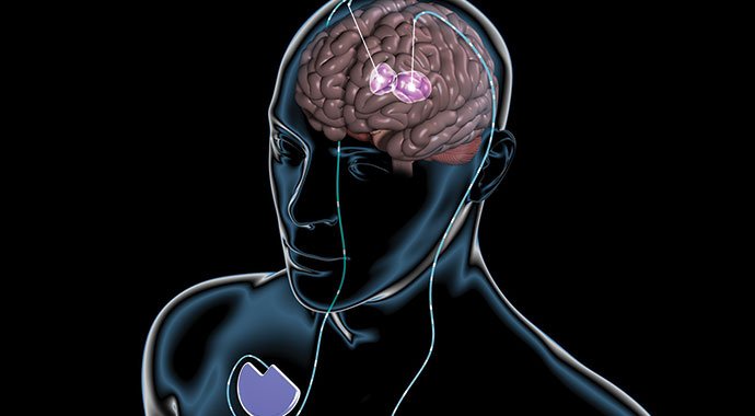 CleClinicMD's tweet image. Targeted electrical stimulation via DBS may hold promise for Huntington’s disease pts cle.clinic/1SEsPeM