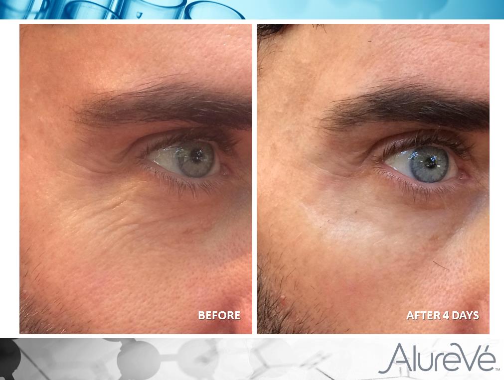 AlureVe's tweet image. Check out the change in this man's skin after just 4 days using the NEW SCIENCE &amp;amp; DELIVERY SYSTEM found in #AlureVé