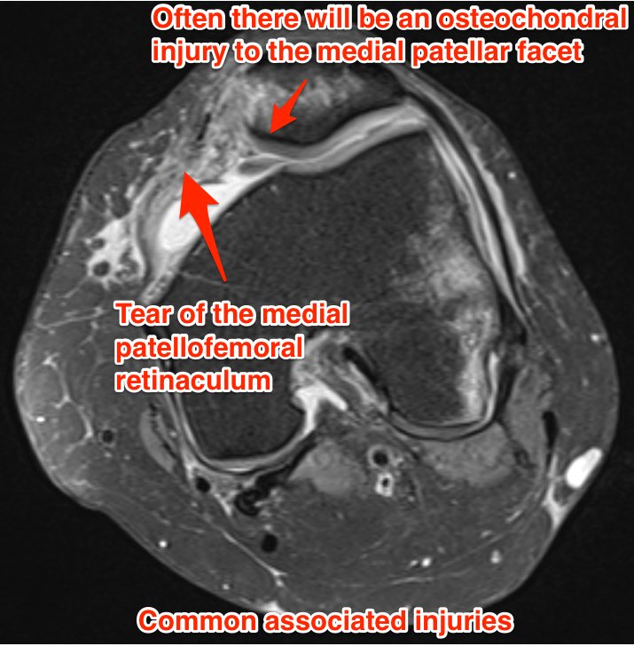 YorkshireRad's tweet photo. More info on the transient patellar dislocation case. Explaining bone oedema pattern and associated injuries #FOAMed https://t.co/AeY0yA0ClV