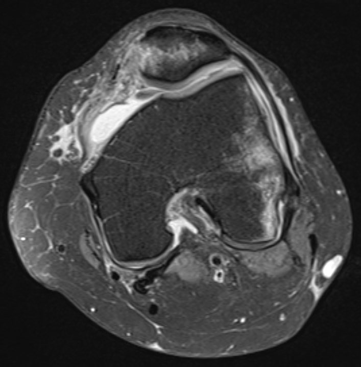 YorkshireRad's tweet photo. More info on the transient patellar dislocation case. Explaining bone oedema pattern and associated injuries #FOAMed https://t.co/AeY0yA0ClV