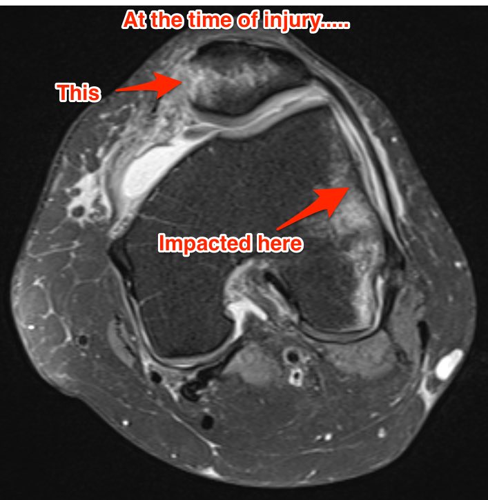YorkshireRad's tweet photo. More info on the transient patellar dislocation case. Explaining bone oedema pattern and associated injuries #FOAMed https://t.co/AeY0yA0ClV