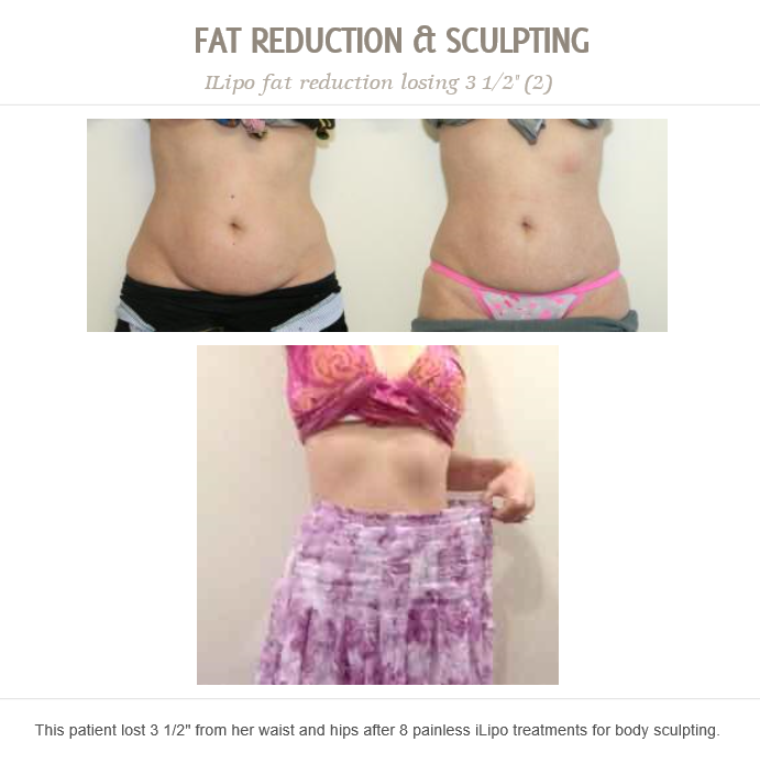 DrJonPerlman's tweet photo. This patient lost 3.5 inches from her waist and hips after 8 painless iLipo treatments for body sculpting. https://t.co/uz0jgDPLQE