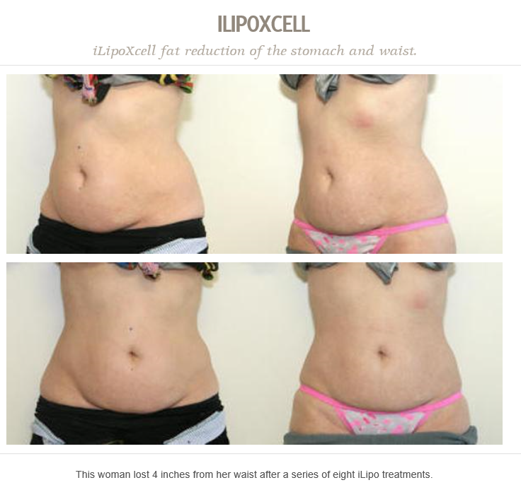 DrJonPerlman's tweet photo. This woman lost 4 inches from her waist after a series of eight iLipo treatments. https://t.co/MbcxkYRSfN