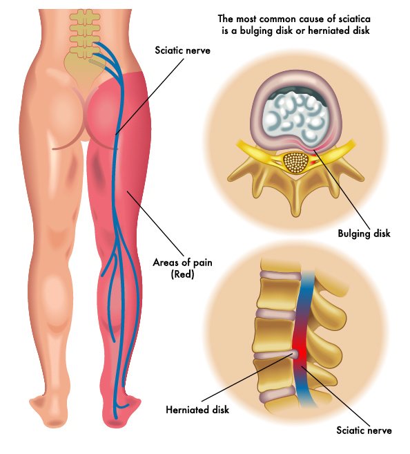 PhxSpine's tweet image. What in the world is a #spinaldisc and why is it herniated? hubs.ly/H01qQNz0