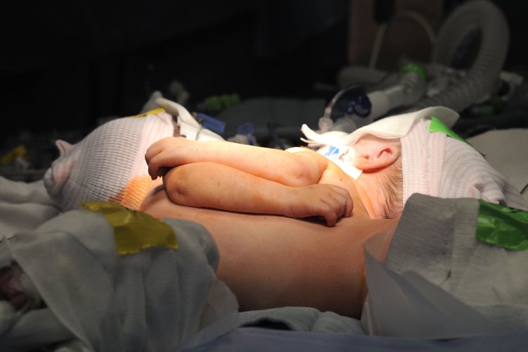 PaulMiles840's tweet photo. BREAKING: 7-week-old conjoined twin girls separated in surgery at Kosair Children's Hospital in Louisville. https://t.co/t0bCDvXteN