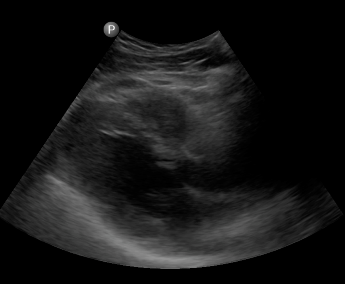 EricTopol's tweet image. A big day for smartphone ultrasound: probe connect to Droid phone; $199/mo @philipshealth lumify.philips.com/web/