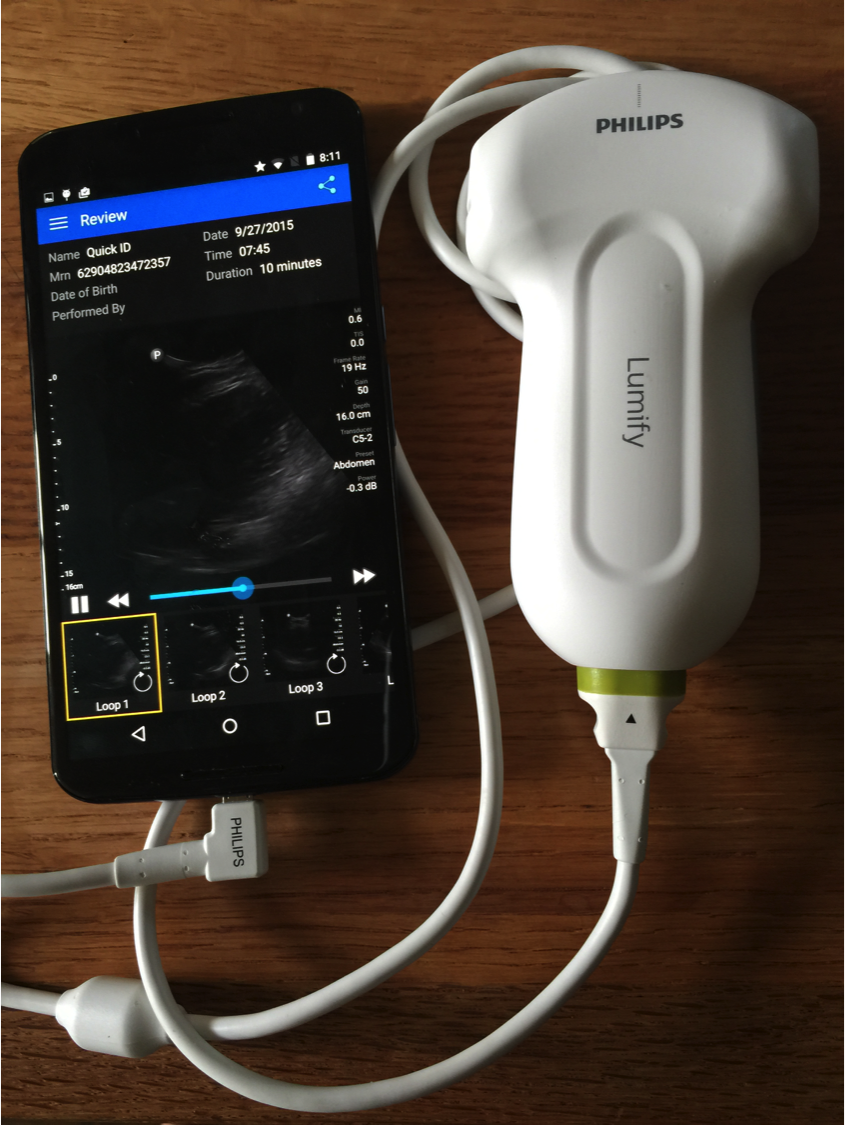 EricTopol's tweet image. A big day for smartphone ultrasound: probe connect to Droid phone; $199/mo @philipshealth lumify.philips.com/web/