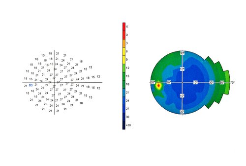 RachelDio's tweet photo. Find out the benefits of Visual field testing and how it glaucoma

https://t.co/DJjDOPoCCq

#visualfieldtesting #eye https://t.co/pNDn3jCtTU