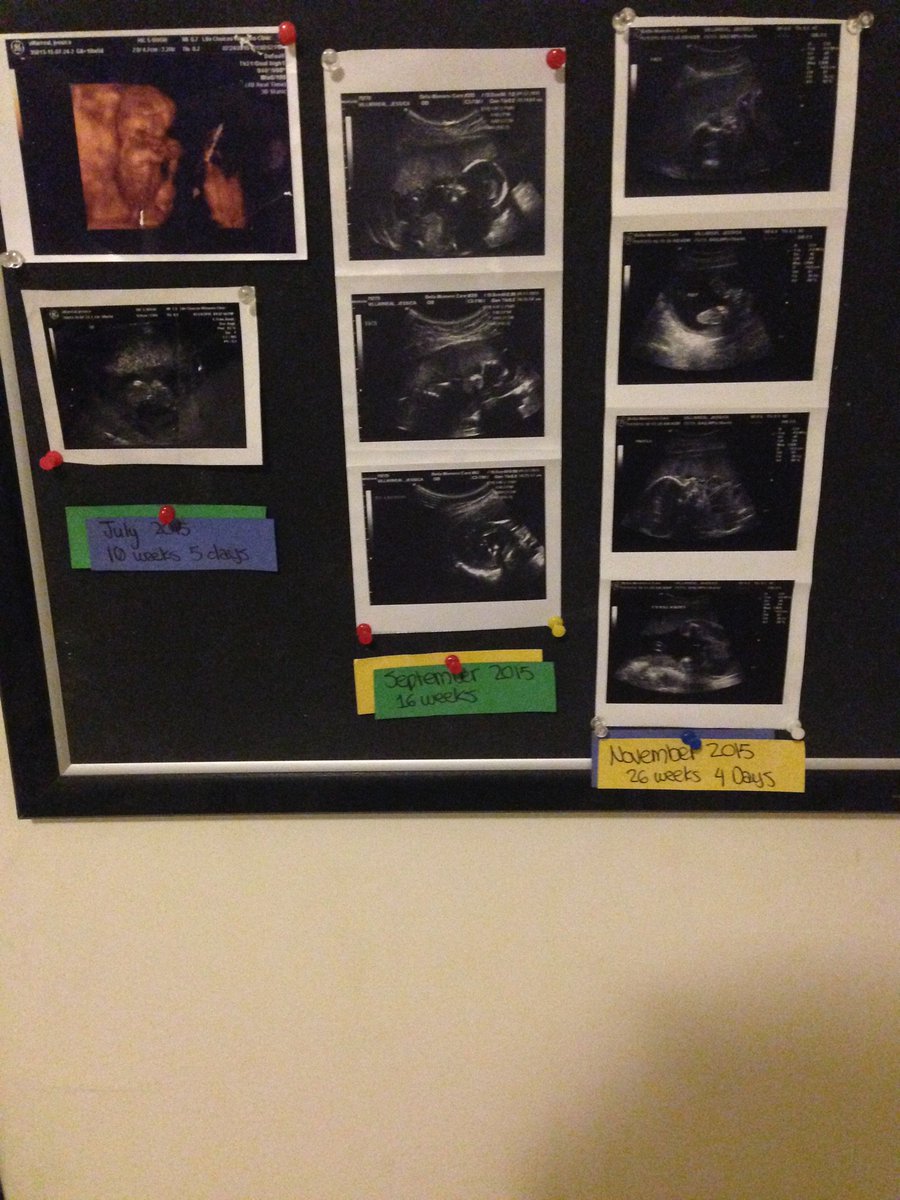 jessiejunoo's tweet photo. All of his ultrasounds so faar! https://t.co/PBq6dRS145