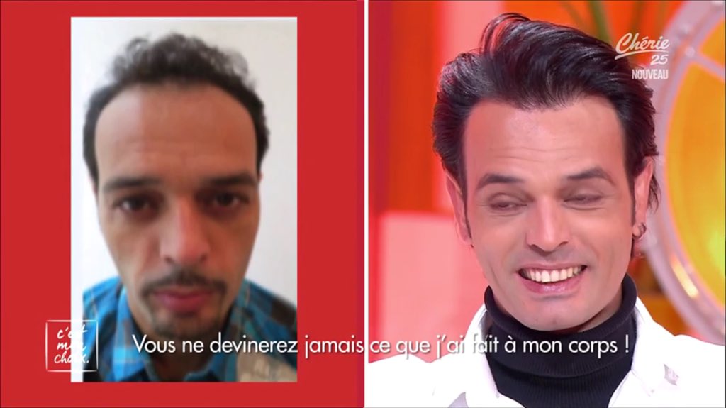 CestMonChoixOff's tweet photo. Avant/Après la chirurgie ! Vous en pensez quoi chez vous ? #CMonChoix https://t.co/Gn8PfHZUrA