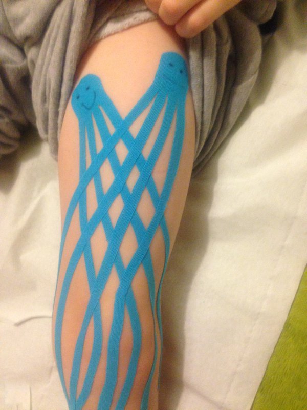 Theratape on Twitter "RT ersportstherapy JellyFish taping using
